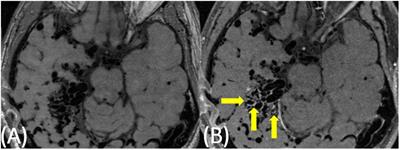 Presence of Vessel Wall Hyperintensity in Unruptured Arteriovenous Malformations on Vessel Wall Magnetic Resonance Imaging: Pilot Study of AVM Vessel Wall “Enhancement”